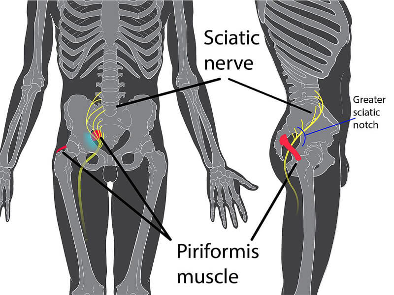 سندروم پیریفورمیس چیست؟